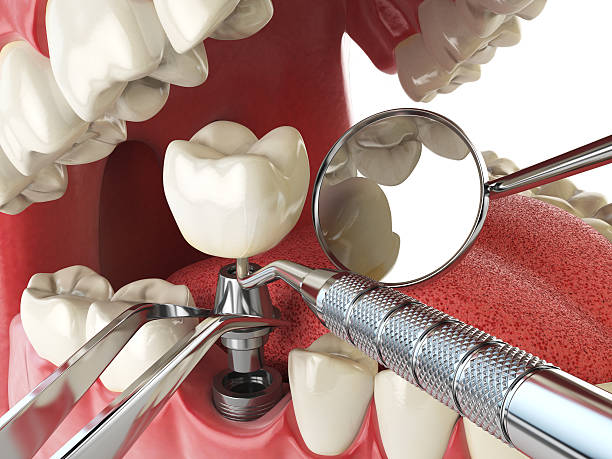 Best Emergency Dentist for Lost Fillings or Crowns in USA